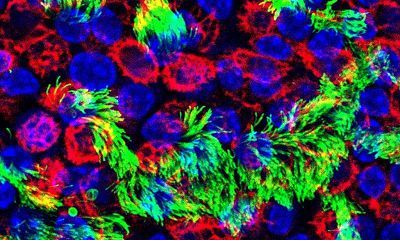 近期干细胞临床试验研究进展